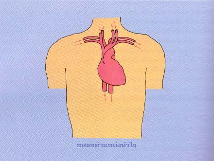 การผ่าตัดเปลี่ยนหัวใจ
