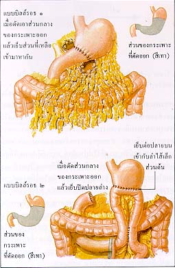 การผ่าตัดเพื่อเปลี่ยนแปลงการทำงานของอวัยวะของร่างกาย