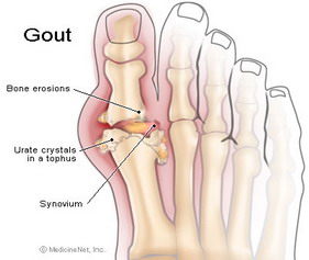โรคเกาต์ Gout