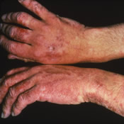 ผื่นแพ้จากการสัมผัส Contact dermatitis