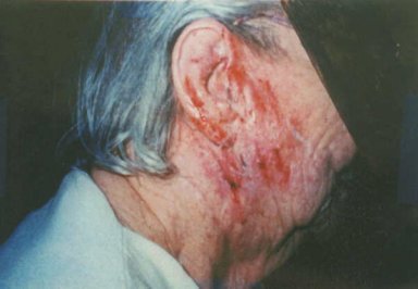 ผื่นแพ้จากกรรมพันธุ์ Eczema/Atopic Dermatitis