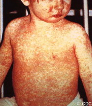 โรคหัด (Measles)