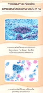 การตรวจคัดกรองโรคมะเร็งปากมดลูก