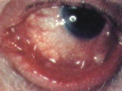 โรคตาแดงจากเชื้อไวรัส (Hemorrhagic Conjunctivitis)