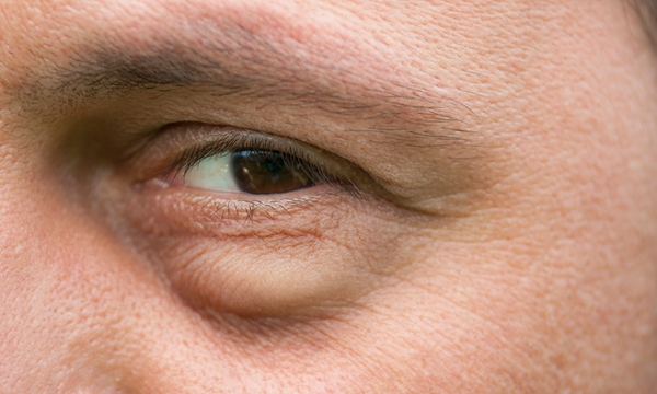 “หนังตาตก” สาเหตุหนึ่งของอาการผิดปกติในร่างกาย