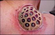 trypophobia โรคกลัวรู คำฮิตในโลกโซเชียล