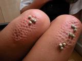 trypophobia โรคกลัวรู คำฮิตในโลกโซเชียล