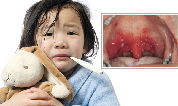 เริ่มระบาดแล้ว! โรค “เฮอร์แปงไจน่า” ตุ่มแผลในปากเด็ก