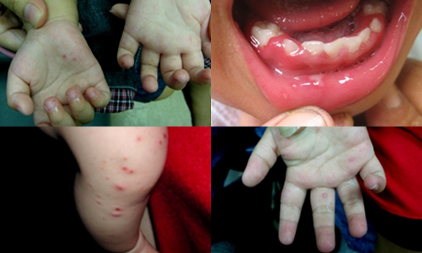 โรค มือ-เท้า-ปาก และโรคจากเชื้อเอนเตอโรไวรัส 71